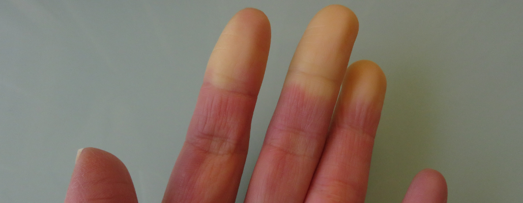 Esclerodermia: cuando el cuerpo se endurece por dentro… y por fuera