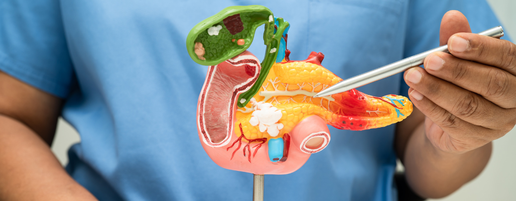 Cáncer de páncreas: Comprendiendo y apoyando la salud integral