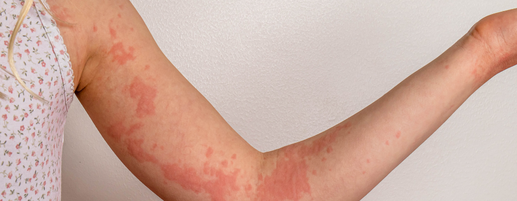 Urticaria crónica: Entendiendo la condición desde un enfoque funcional