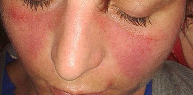 Lupus: cuando el sistema inmune se confunde (y cómo abordarlo desde lo funcional)