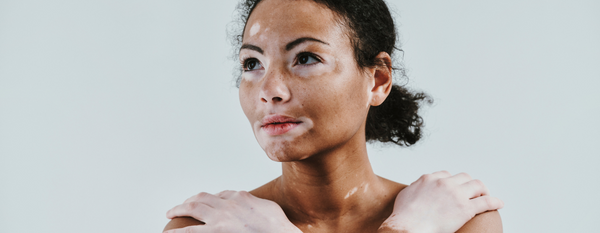 Enfoque integral del vitiligo