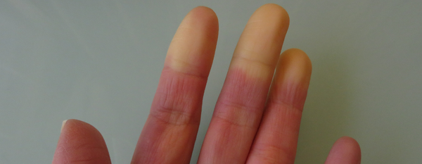 Esclerodermia: cuando el cuerpo se endurece por dentro… y por fuera