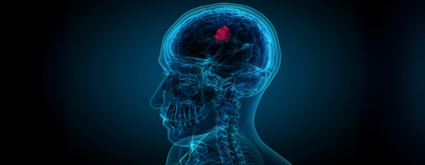 Tumores cerebrales: comprender, prevenir y apoyar la salud cerebral desde la medicina funcional
