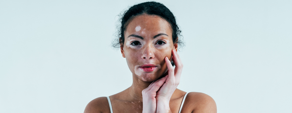 Vitiligo: comprendiendo la piel más allá del color