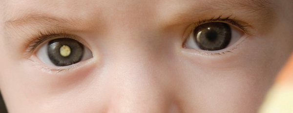 Enfermedad de Coats: Entendiendo y apoyando la salud ocular desde un enfoque funcional