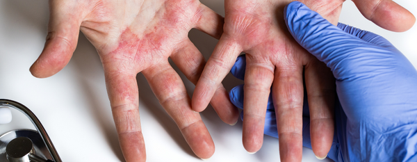 Dermatitis atópica: enfoque funcional para sanar de adentro hacia afuera