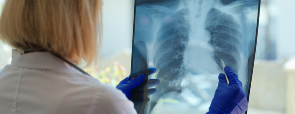 Fibrosis quística: Cómo apoyar el cuerpo desde un enfoque funcional