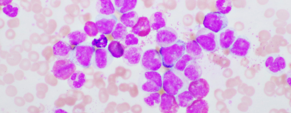 Leucemia mieloide crónica (LMC): Un abordaje integral y funcional