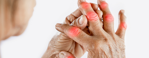 Artritis: Comprendiendo la inflamación articular desde un enfoque funcional