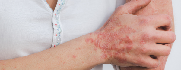 Psoriasis: Entendiendo y cuidando la piel desde un enfoque funcional