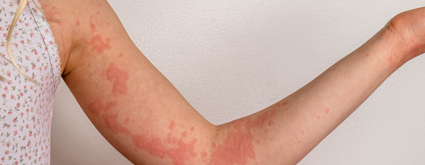 Urticaria crónica: Entendiendo la condición desde un enfoque funcional