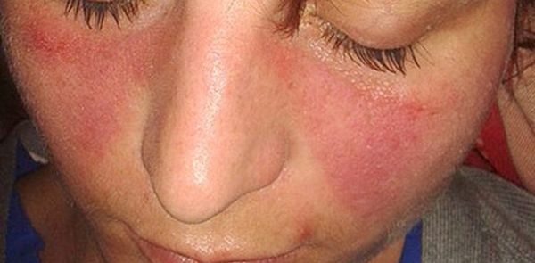 Lupus: cuando el sistema inmune se confunde (y cómo abordarlo desde lo funcional)
