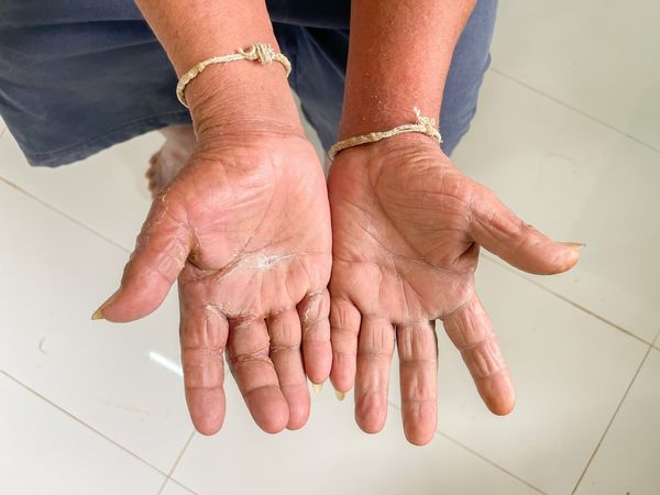 Esclerodermia desde un enfoque funcional
