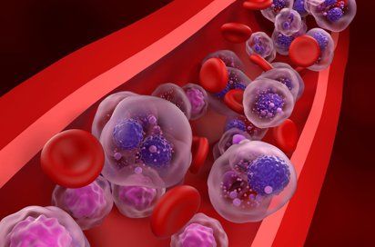 Mieloma múltiple desde un enfoque funcional: nutrición y cuidado integral